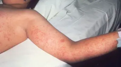 FDOH: Child infected with measles in Broward